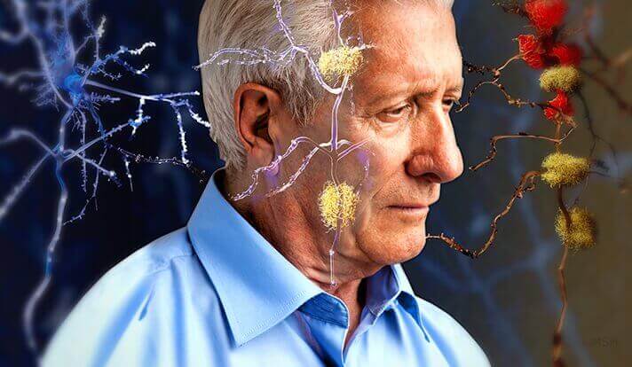 Mann med faresignaler på Alzheimers