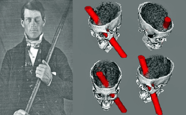 Phineas Gage og hjernen