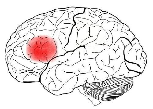 hjerne med broca-området uthevet i rødt