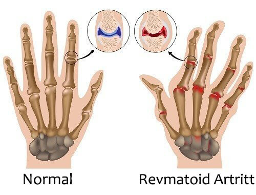 Revmatoid Artritt