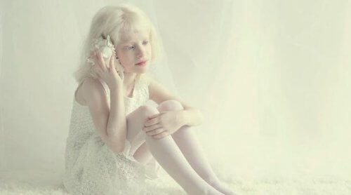 Liten jente med albinisme.