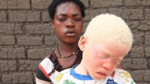 Svart person bak en albino.