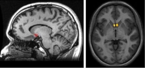 Nucleus accumbens i hjernen.