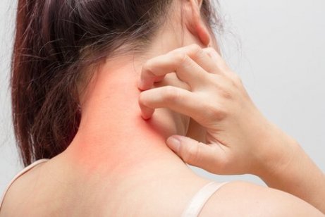 Atopisk dermatitt manifesterer seg ofte på leddene