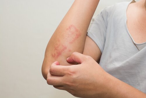 Seks tips for å behandle atopisk dermatitt