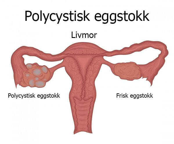 Polycystisk ovariesyndrom: Lær alt om det her