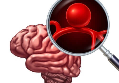 En utposning på blodårene i hjernen kalles en intrakranial aneurisme.