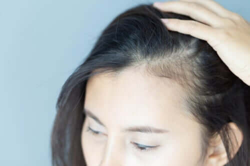 Alopecia hos kvinner – De psykiske konsekvensene