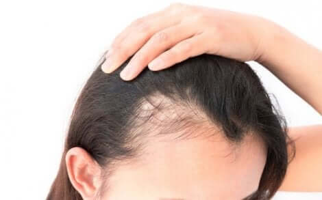 I de vanligste formene for alopecia hos kvinner, vil hårfestet forbli uberørt av tilstanden.