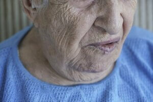 Ansiktslammelse: Årsaker og behandlinger