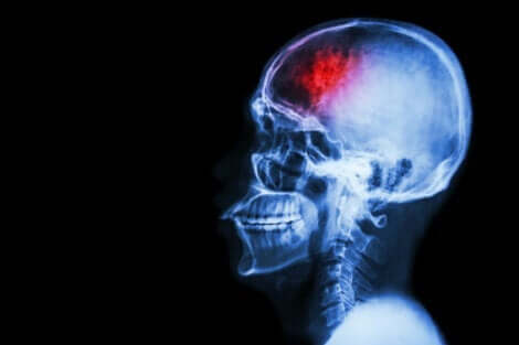 En CT-skanning av hjernen etter hjerneslag.
