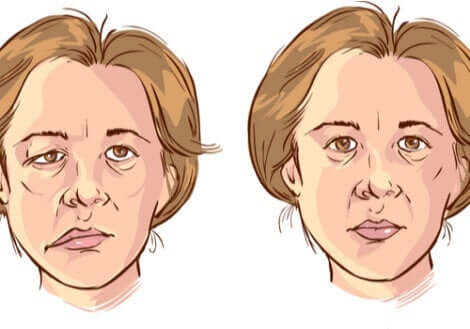 En illustrasjon av en kvinne med ansiktslammelse.