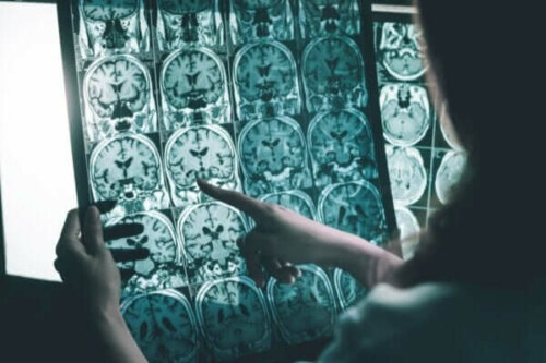 Hjernebølgestimulering for mennesker med Alzheimers