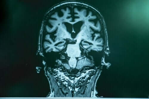 Røntgen av hjerne.