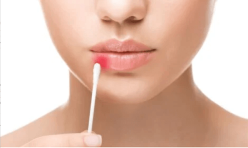 Kvinne med forkjølelsessår.