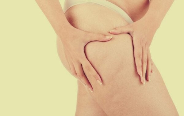 Lipødem: utover fedme